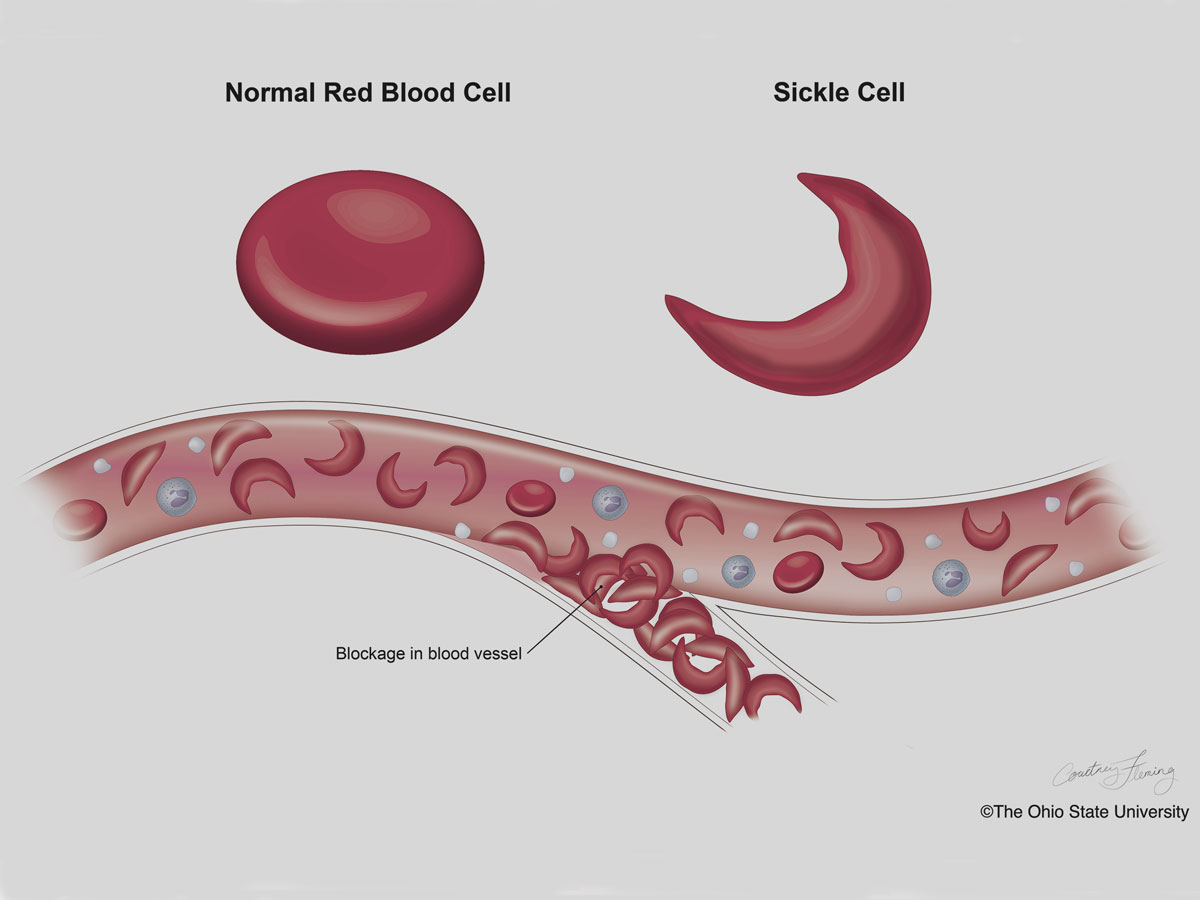 Sickle Cell Image